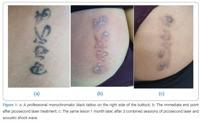 laser tattoo laser tattoo